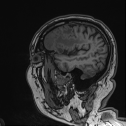 Atypical meningioma (WHO grade II) with brain invasion (Radiopaedia 57767-64729 Sagittal T1 52).png