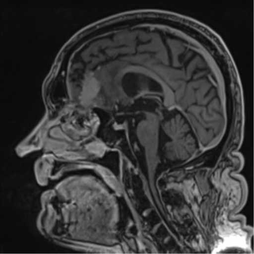 Atypical meningioma (WHO grade II) with brain invasion (Radiopaedia 57767-64729 Sagittal T1 C+ 35).png