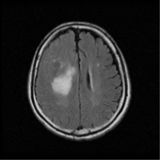 File:Atypical meningioma with skull invasion (Radiopaedia 34357-35648 Axial FLAIR 15).png