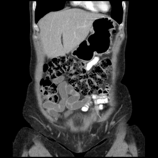 File:Atypical renal cyst (Radiopaedia 17536-17251 C 31).jpg