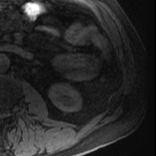 File:Atypical renal cyst on MRI (Radiopaedia 17349-17046 Axial T1 fat sat 27).jpg