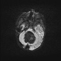 File:Atypical teratoid rhabdoid tumor (prenatal US and neonatal MRI) (Radiopaedia 59091-66388 Axial DWI 1).jpg