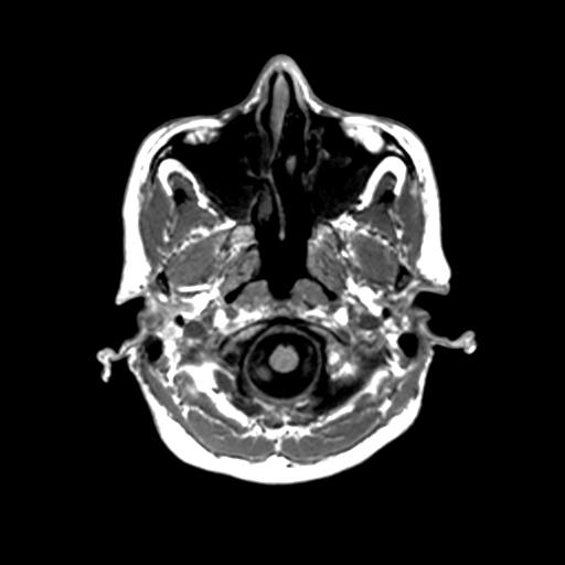 Autoimmune limbic encephalitis (Radiopaedia 30363-31005 T1 Axial 1mm 20).jpg