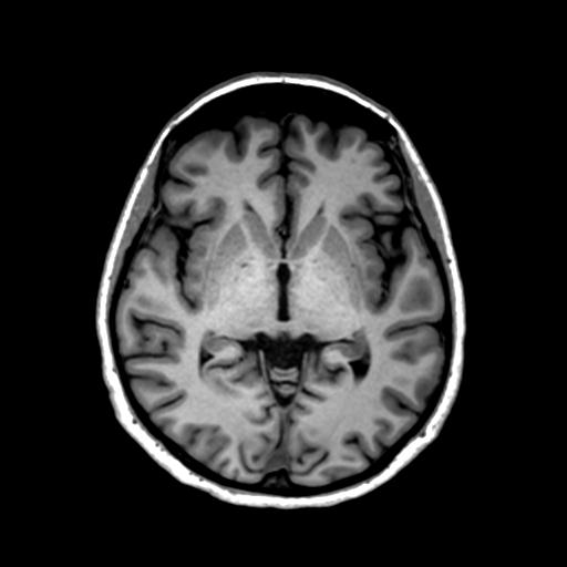 Autoimmune limbic encephalitis (Radiopaedia 30363-31005 T1 Axial 1mm 74).jpg