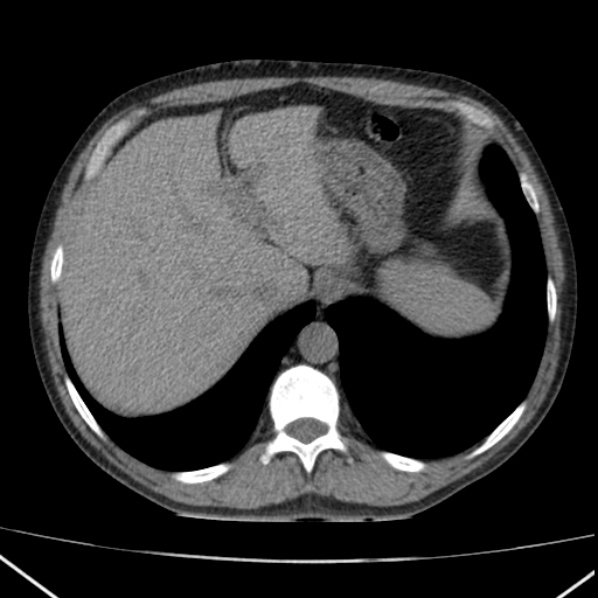 File:Autosomal dominant polycystic kidney disease (Radiopaedia 36539-38101 Axial non-contrast 14).jpg