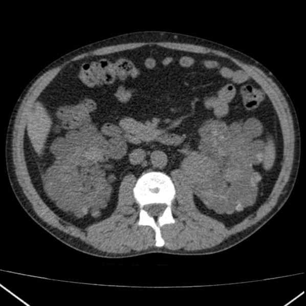 File:Autosomal dominant polycystic kidney disease (Radiopaedia 36539-38101 Axial non-contrast 38).jpg