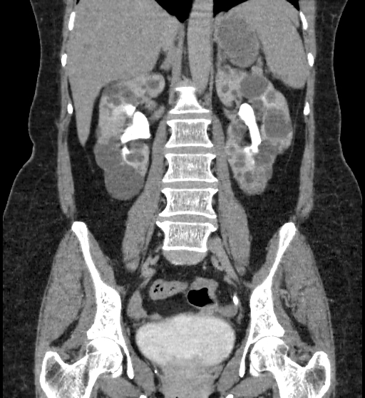 File:Autosomal dominant polycystic kidney disease (Radiopaedia 38189-40194 Coronal C+ delayed 56).jpg