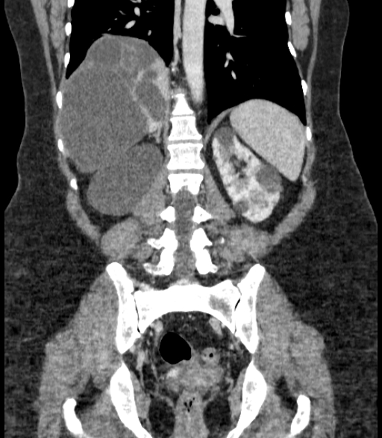 Autosomal dominant polycystic kidney disease (Radiopaedia 57124-64017 B 54).jpg