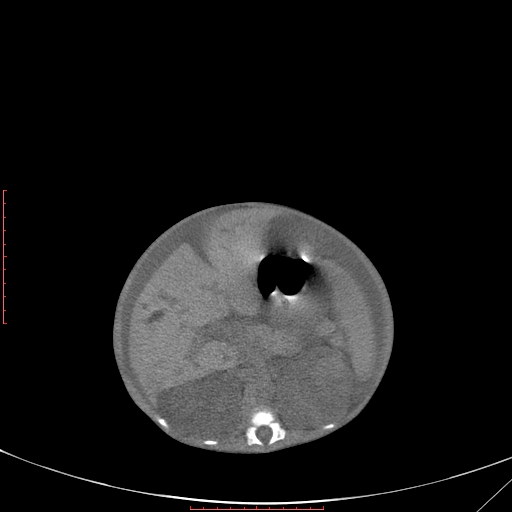 Autosomal recessive polycystic kidney disease associated with Caroli disease (Radiopaedia 61932-69984 Axial non-contrast 171).jpg