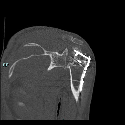 Avascular necrosis after fracture dislocations of the proximal humerus (Radiopaedia 88078-104655 Coronal bone window 74).jpg
