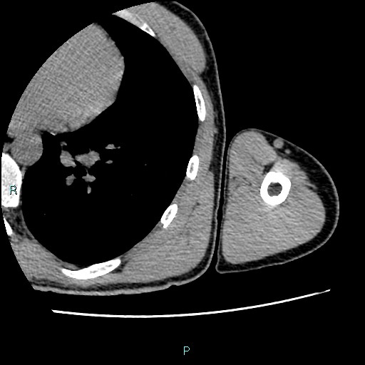 File:Avascular necrosis after fracture dislocations of the proximal humerus (Radiopaedia 88078-104655 D 113).jpg
