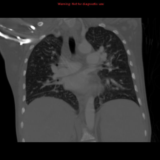 Avascular necrosis in sickle cell disease (Radiopaedia 17448-17152 Coronal bone window 70).jpg