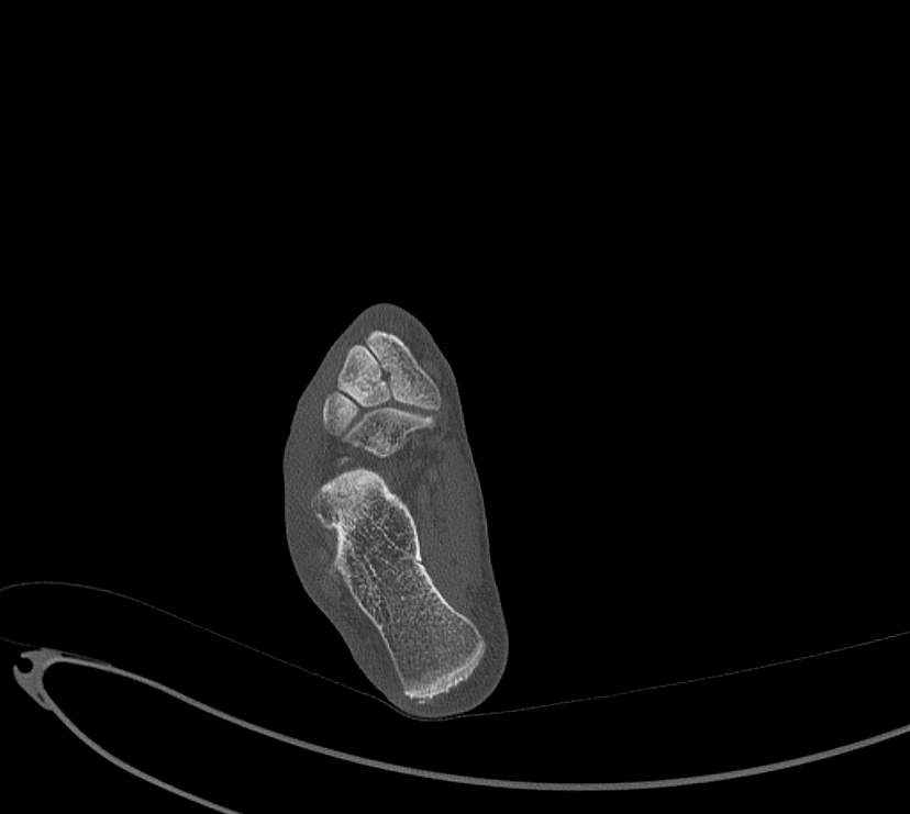 Avulsion fractures of talus and calcaneus (Radiopaedia 48277-53155 Axial bone window 75).jpg