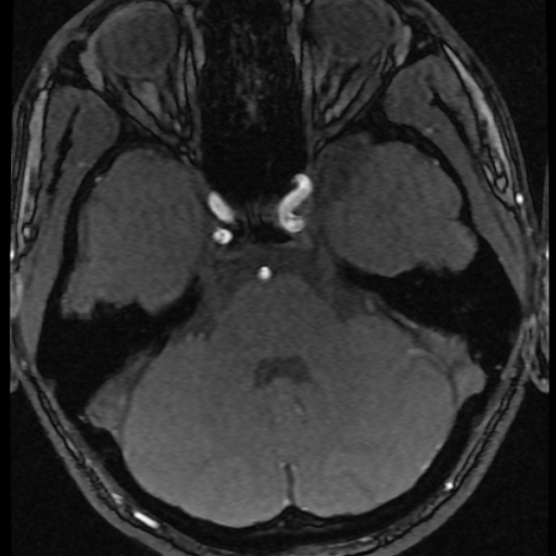 Azygos anterior cerebral artery (Radiopaedia 17059-16756 Axial MRA 62).jpg
