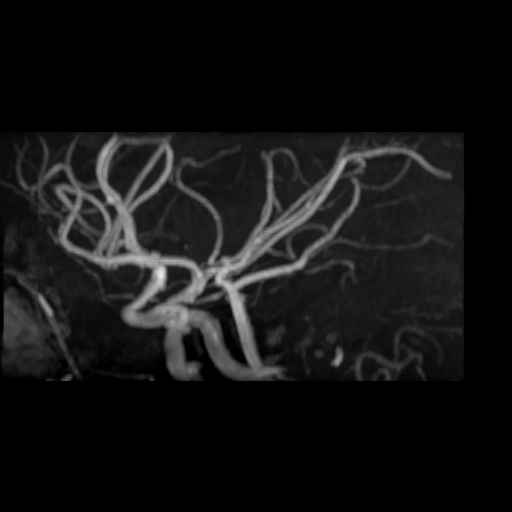 File:Azygos anterior cerebral artery (Radiopaedia 17059-16756 MRA 9).jpg