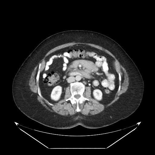 File:B-cell lymphoma of the mesentery (Radiopaedia 65711-74827 A 62).jpg