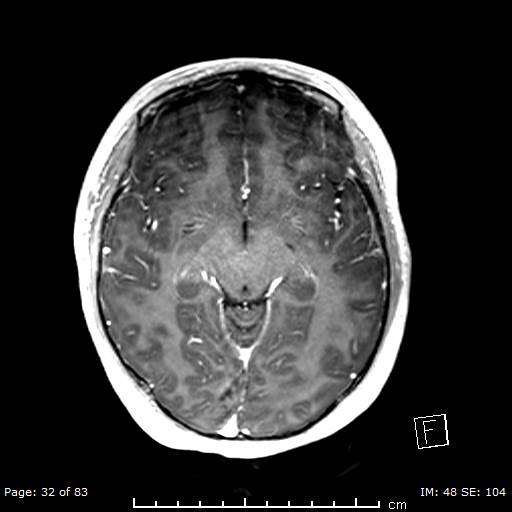 Balo concentric sclerosis (Radiopaedia 61637-69636 Axial T1 C+ 32).jpg