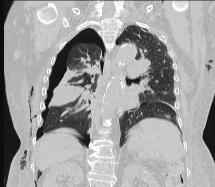 Barotrauma due to mechanical ventilation (Radiopaedia 28079-28336 Coronal lung window 61).jpg