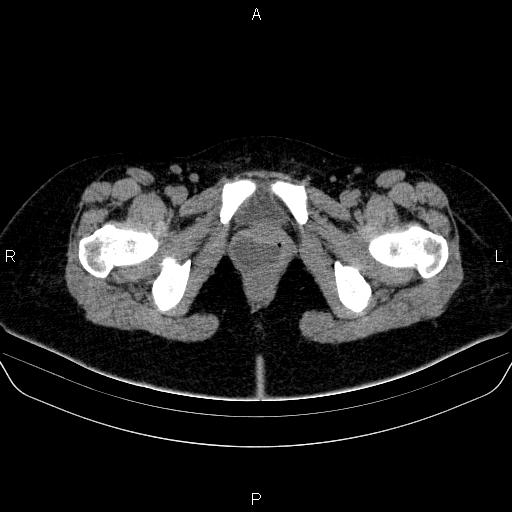 Bartholin gland cyst (Radiopaedia 62635-70930 Axial non-contrast 80).jpg