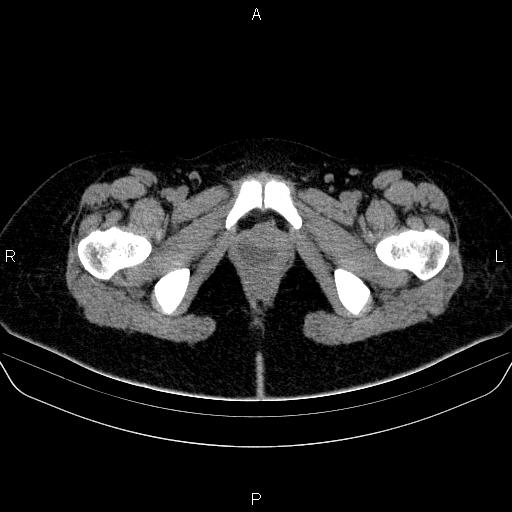 Bartholin gland cyst (Radiopaedia 62635-70930 Axial non-contrast 83).jpg