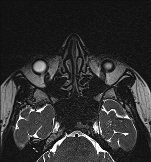 Basal cell carcinoma - nasal region (Radiopaedia 70292-80365 Axial Gradient Echo 55).jpg