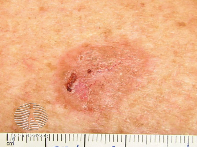 File:Basal cell carcinoma affecting the trunk (DermNet NZ lesions-bcc-trunk-0672).jpg