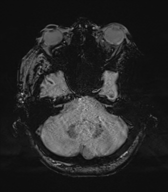 Basal ganglia metastasis (Radiopaedia 78928-91828 Axial SWI 18).png