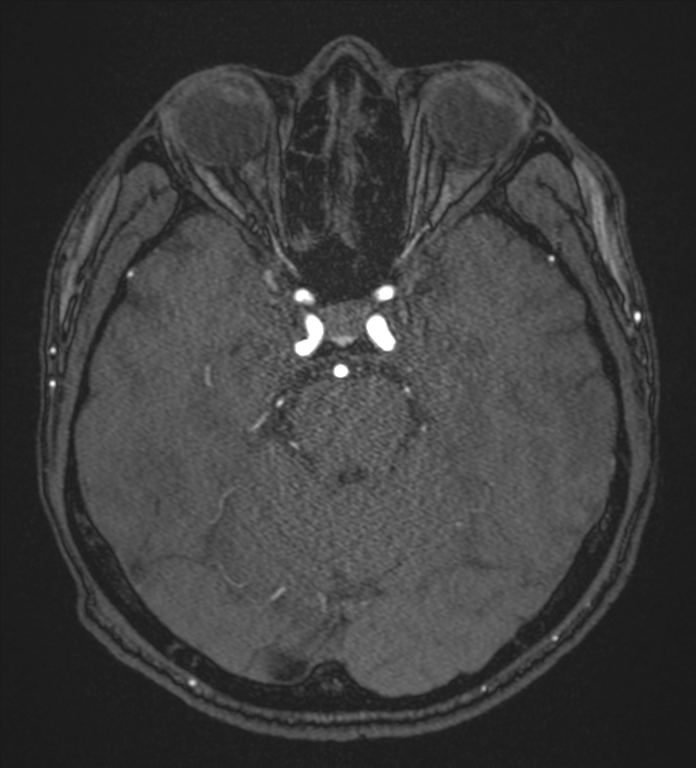 Basal ganglia subacute infarct (Radiopaedia 80201-93521 Axial MRA 39).png