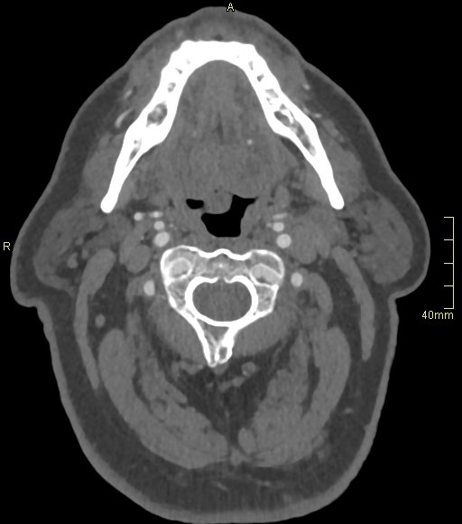 File:Basilar artery aneurysm (Radiopaedia 56261-62932 A 15).jpg