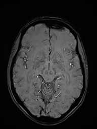 Basilar artery perforator aneurysm (Radiopaedia 82455-97733 Axial SWI 25).jpg