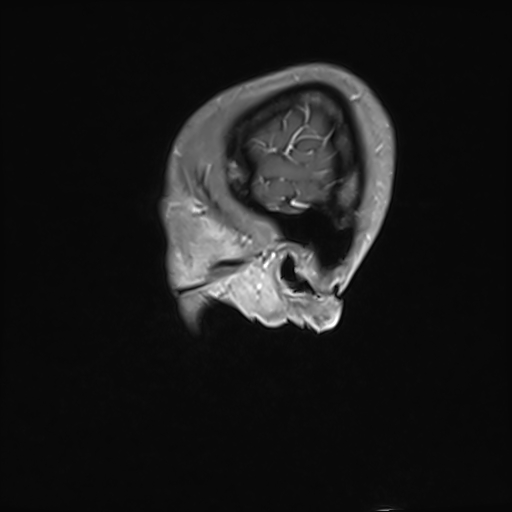 Basilar artery perforator aneurysm (Radiopaedia 82455-97733 G 14).jpg