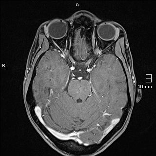 Basilar artery perforator aneurysm (Radiopaedia 82455-99523 G 47).jpg