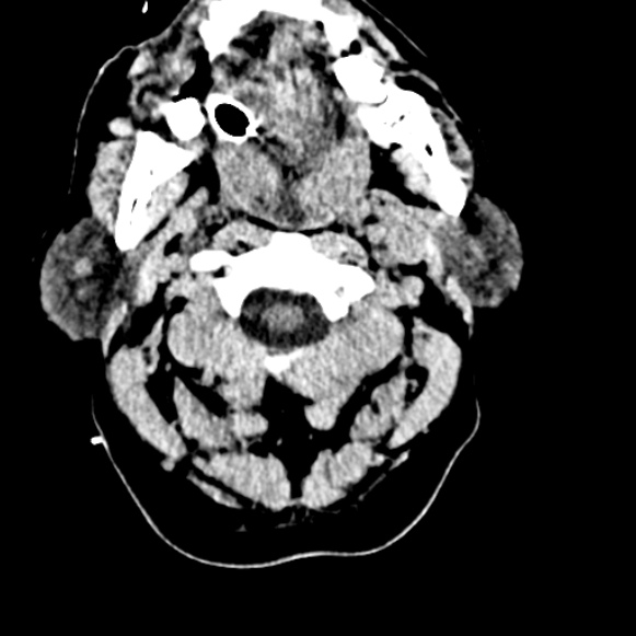 Basilar artery thrombosis (Radiopaedia 53351-59333 Axial non-contrast 6).jpg