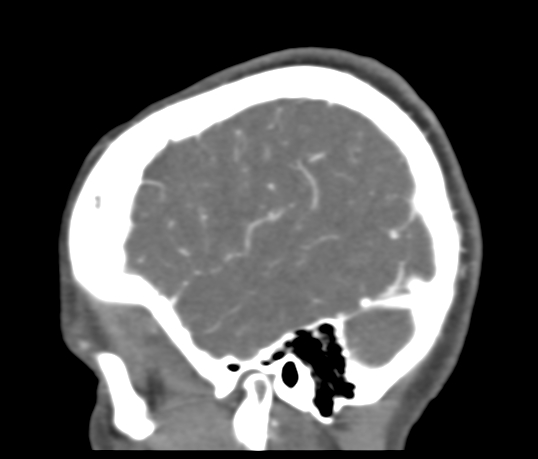 Basilar tip aneurysm with coiling (Radiopaedia 53912-60086 C 115).jpg