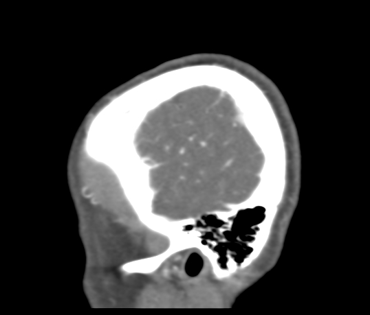 File:Basilar tip aneurysm with coiling (Radiopaedia 53912-60086 C 126).jpg
