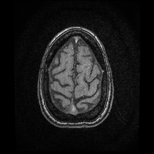 Basilar top and left middle cerebral artery aneurysm (Radiopaedia 61965-70031 Axial MRA 156).jpg
