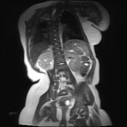 File:Beckwith-Wiedeman syndrome with bilateral Wilms tumors (Radiopaedia 60850-69233 B 8).jpg