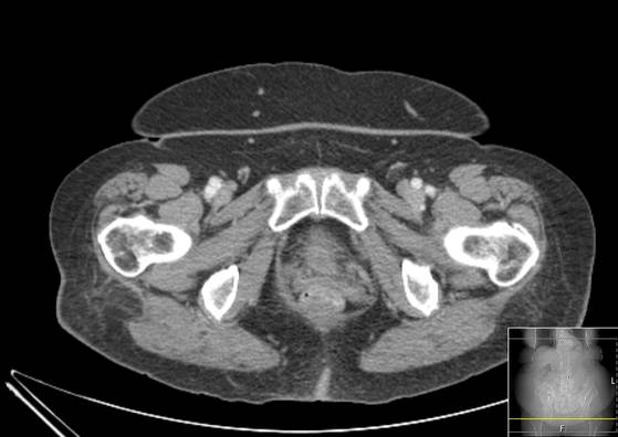 Bicameral celiacomesenteric aneurysm (Radiopaedia 55766-62327 A 74).jpg
