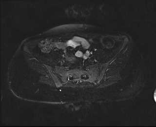 File:Bicornuate bicollis uterus (Radiopaedia 61626-69616 Axial PD fat sat 8).jpg