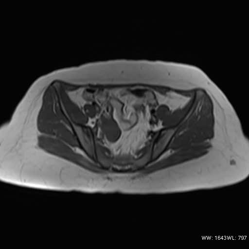 File:Bicornuate uterus- on MRI (Radiopaedia 49206-54297 Axial T1 4).jpg