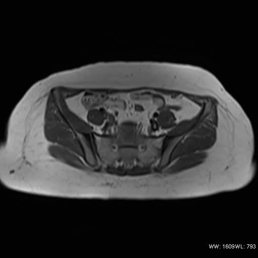 File:Bicornuate uterus (MRI) (Radiopaedia 49206-54297 Axial 21).jpg