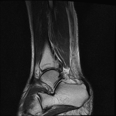 File:Bilateral Achilles tendon complete tear (Radiopaedia 81344-95051 Sagittal T2 26).jpg