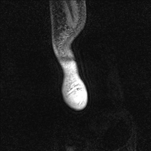 Bilateral Achilles tendon complete tear (Radiopaedia 81344-95051 Sagittal WE - Left 108).jpg