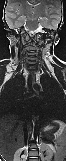 File:Bilateral Sprengel deformity with Klippel-Feil syndrome (Radiopaedia 66395-75650 F 2).jpg