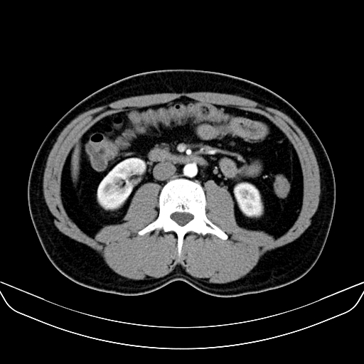 Bilateral accessory renal arteries with mild pelvi-ureteric junction (PUJ) obstruction (Radiopaedia 66357-75596 A 30).jpg