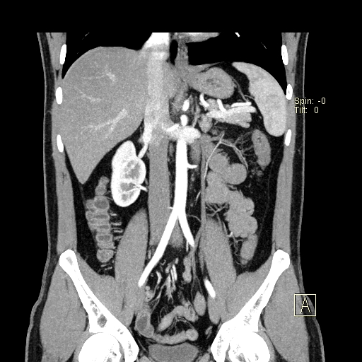 File:Bilateral accessory renal arteries with mild pelvi-ureteric junction (PUJ) obstruction (Radiopaedia 66357-75596 B 17).jpg