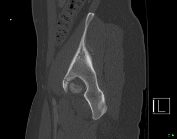 Bilateral acetabular fractures (Radiopaedia 79272-92308 Sagittal bone window 22).jpg