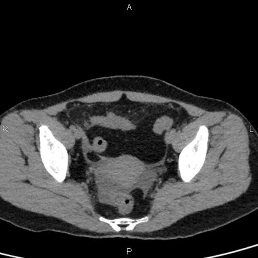 Bilateral adrenal gland hyperenhancement in pancreatitis (Radiopaedia 86642-102753 Axial non-contrast 97).jpg