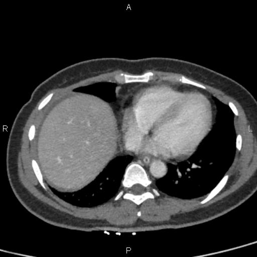 Bilateral adrenal gland hyperenhancement in pancreatitis (Radiopaedia 86642-102753 E 4).jpg