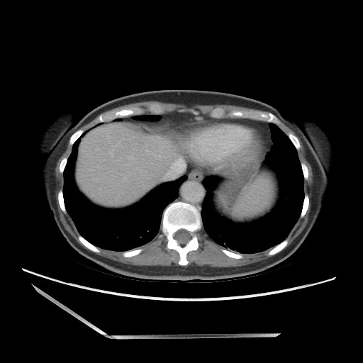 File:Bilateral adrenal granulocytic sarcomas (chloromas) (Radiopaedia 78375-91007 Axial 105).jpg